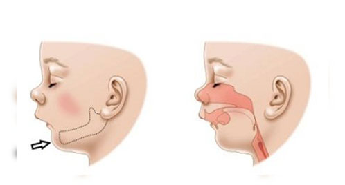 سندروم پیررابین