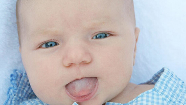 درمان برفک دهان در نوزادان